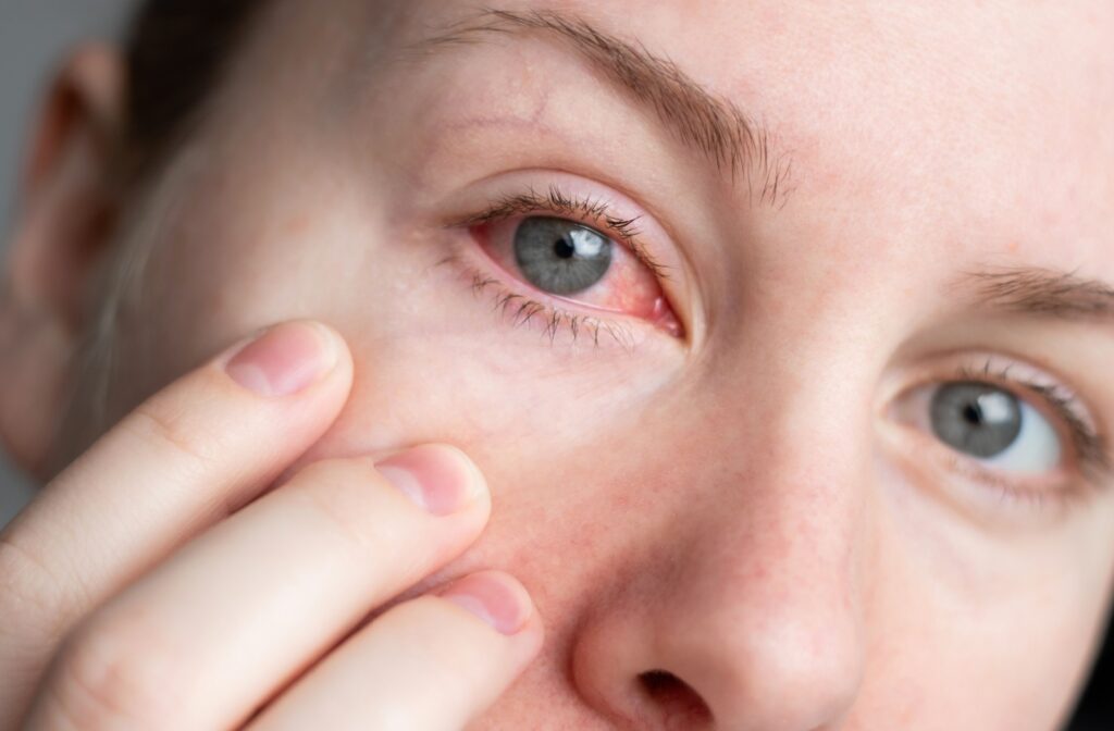 Close up of a person at the skin under their eye to better show their red eye