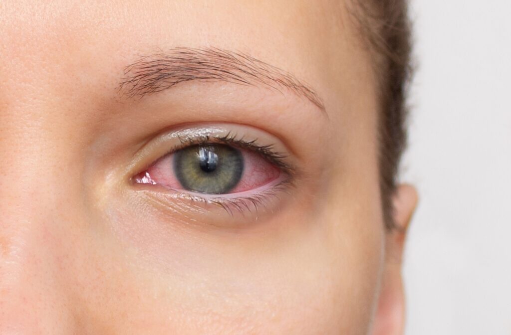 A close up of a red eye irritated from dry eye