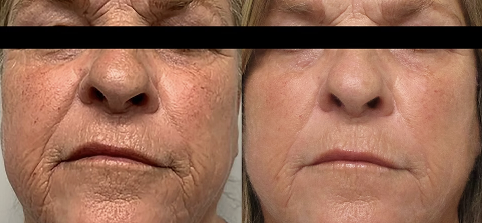 Before and after results of Morpheus8
